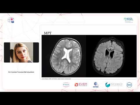 Видео: Эпилепсия при дефиците переносчика глюкозы. Болезнь де Виво. Алтунина Г.Е.