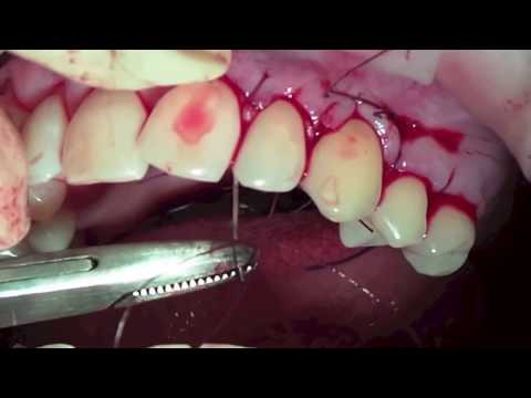 Видео: Устранение множественных рецессий десны. Мария Александровна Носова.