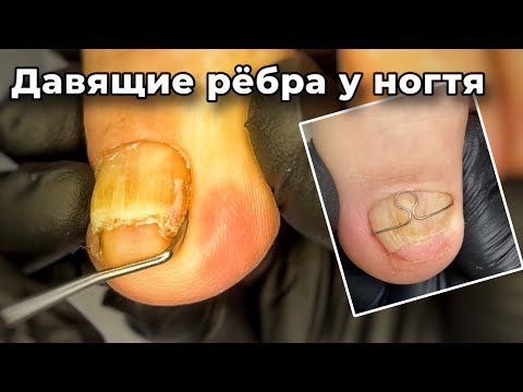 Видео: Паралич нижних конечностей. Кожные массы на скомканном ногтевом ложе.