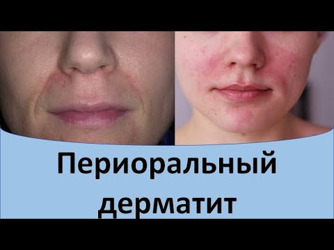 Видео: Периоральный дерматит