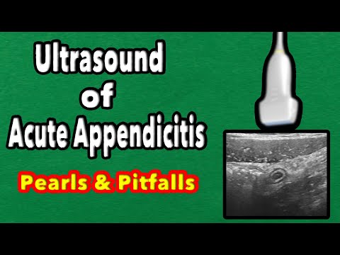Видео: УЗИ острого аппендицита: жемчужины и подводные камни