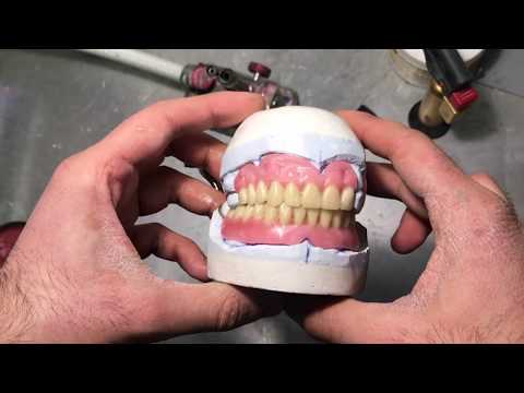 Видео: Постановка зубного протеза.(Этап 2)