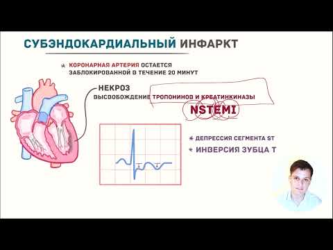 Видео: ЭКГ за 100 минут №7: Ишемия и Инфаркт на ЭКГ