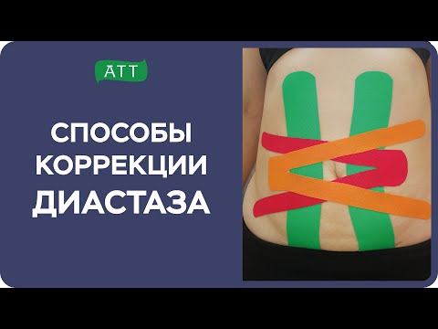 Видео: Диастаз прямых мышц живота. Эстетическое тейпирование. Упражнения при диастазе. Мастер класс.