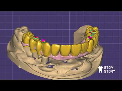 Видео: Изготовление балки с уступом ExoCad + B4D ( blender for dental)