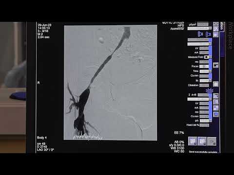 Видео: Баллонная ангиопластика