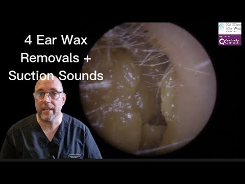 Видео: 4 способа удаления ушной серы и звуки отсасывания! - Эпизод 57 #удалениеушнойсеры