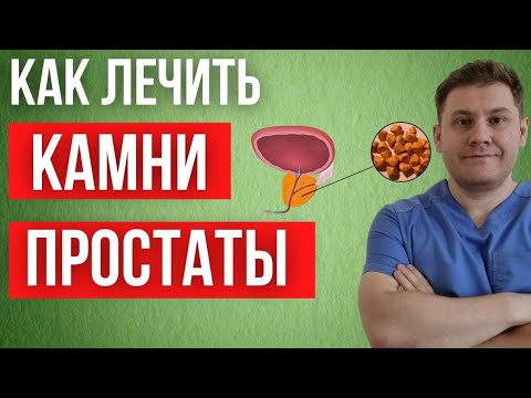 Видео: Как лечить камни ПРЕДСТАТЕЛЬНОЙ ЖЕЛЕЗЫ .