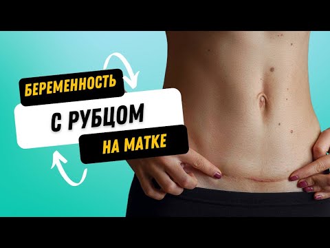 Видео: БЕРЕМЕННОСТЬ С РУБЦОМ НА МАТКЕ @DrOlenaB