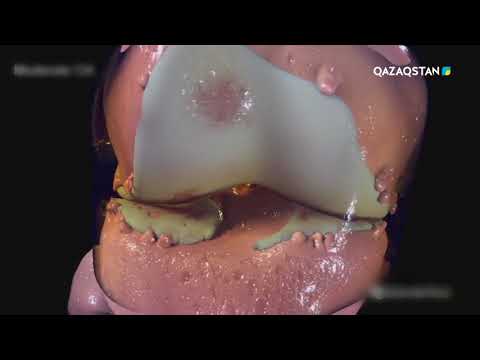 Видео: Шипагер - Буын аурулары. 14-бағдарлама