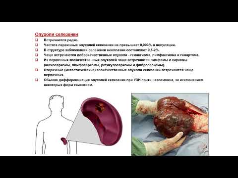 Видео: Ультразвуковая диагностика. Доктор Иогансен. Выпуск 65. Опухоли селезенки.