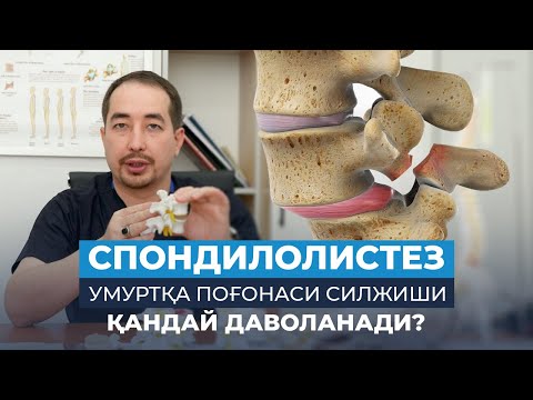 Видео: Спондилолистез қандай Даволанади | Умуртқа Поғонаси Силжиши қандай Даволанади? | NeuroLife
