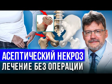 Видео: Асептический некроз головки бедренной кости -как диагностировать, как лечить консервативным способом