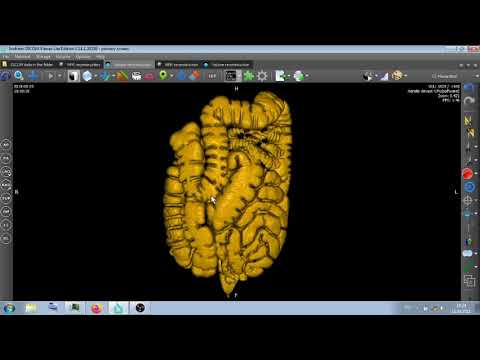 Видео: ВИРТУАЛЬНАЯ КОЛОНОСКОПИЯ .