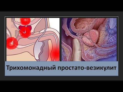 Видео: Трихомонадный простато-везикулит