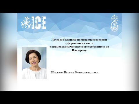 Видео: Лечение больных с  посттравматическими деформациями кисти с применением чрескостного остеосинтеза.