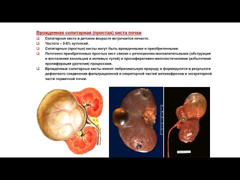 Видео: УЗИ. Доктор Иогансен. Выпуск 73. Аномалии развития почек и мочеточников. Часть 5.