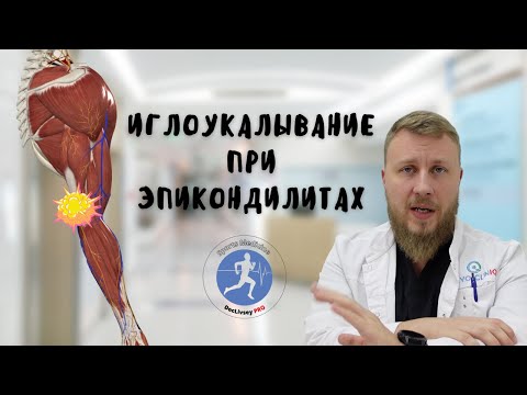 Видео: Эпикондилит латеральный, медиальный | иглоукалывание