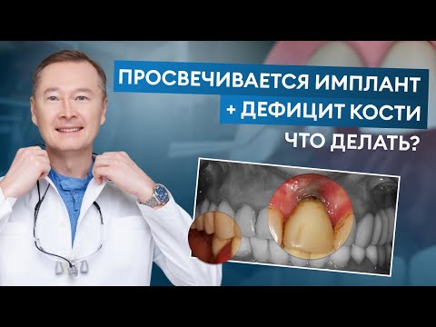 Видео: ЧТО ДЕЛАТЬ: Просвечивается Имплант Через Десну + Дефицит Кости в 4-м Сегменте? Сложный Кейс
