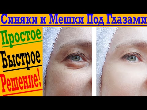 Видео: Нужно всего 2 витамина! Убираем синяки и мешки под глазами быстро!
