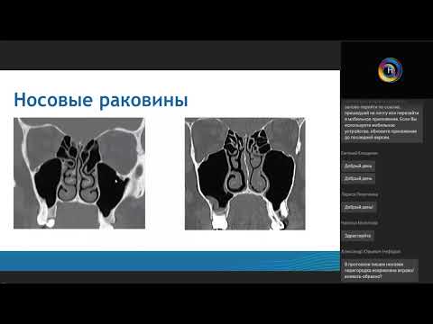 Видео: Компьютерная томография придаточных пазух носа перед FESS