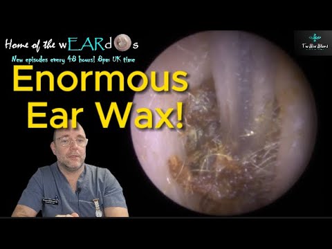 Видео: Огромное количество ушной серы! 226 #ухо #ушнаясера #удовлетворительно #fyp #длявас #длявашейстра...