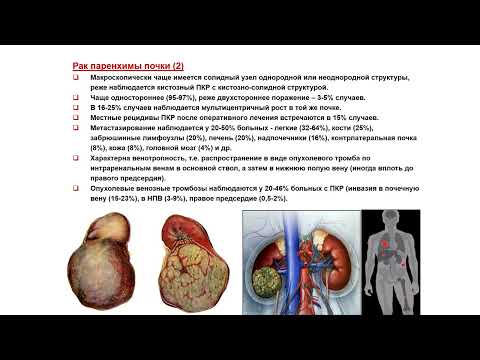 Видео: УЗИ. Доктор Иогансен. Выпуск 89. Опухоли почек и верхних мочевых путей. Часть 1.