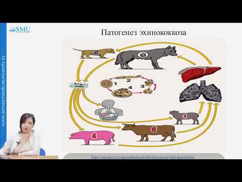 Видео: Эхинококкоз