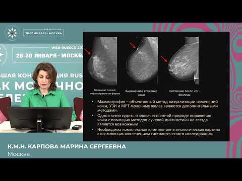 Видео: Должны ли мы стадировать любое утолщение кожи при РМЖ как Т4? Мнение рентгенолога