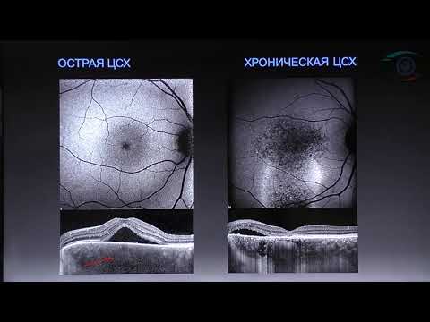 Видео: Педанова. Е.К. Дифференцированный подход к лечению ЦСХ