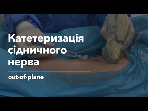 Видео: Катетеризація сідничного нерва | Sciatic Nerve Catheter Placement