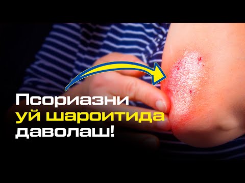 Видео: Псориазни уй шароитида даволаш мумкинми ? | Мурожаат учун: (78) 555-77-17