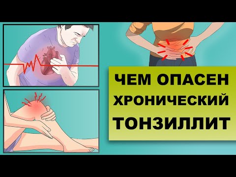 Видео: ЧЕМ ОПАСЕН ХРОНИЧЕСКИЙ ТОНЗИЛЛИТ