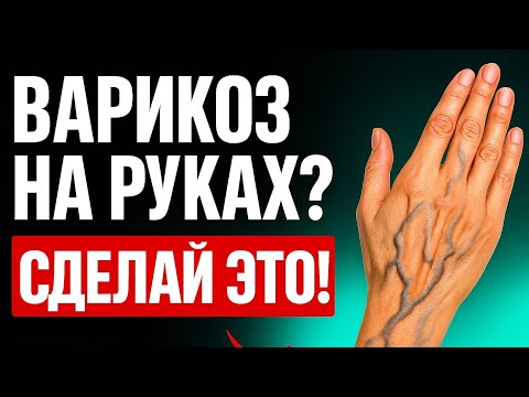 Видео: Где ЕЩЁ «прячется» варикоз? ВАЖНО ЗНАТЬ КАЖДОМУ!