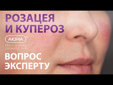 Видео: КУПЕРОЗ и РОЗАЦЕА: вопрос эксперту косметологу-дерматологу | УЦ АЮНА