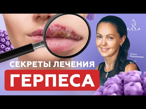 Видео: Как вылечить ГЕРПЕС навсегда | Настоящие причины герпеса (генитальный, на губах, на голове)