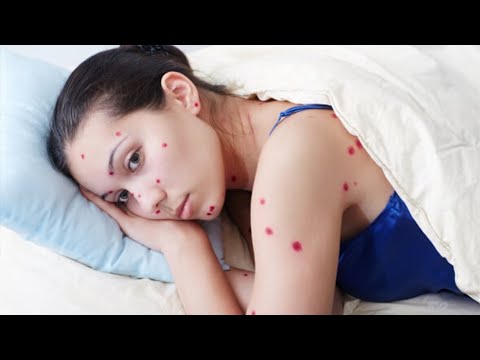 Видео: ПОЧЕМУ ВЕТРЯНКА У ВЗРОСЛЫХ ОПАСНА?