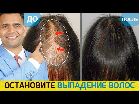 Видео: ОСТАНОВИТЕ ВЫПАДЕНИЕ ВОЛОС