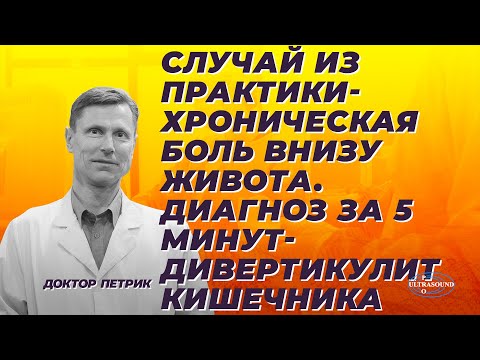 Видео: Случай из практики - хроническая боль внизу живота. Диагноз за 5 минут. Дивертикулит кишечника.
