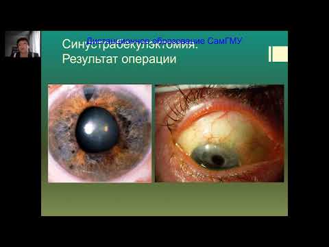 Видео: Глаукома Часть 2