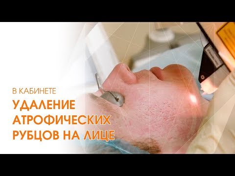 Видео: Как ИЗБАВИТЬСЯ от рубцов НАВСЕГДА / Лазерное удаление атрофических рубцов