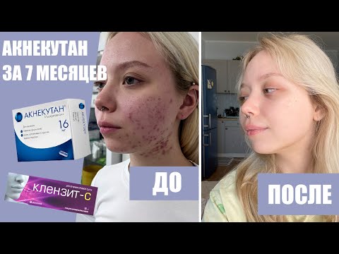 Видео: КАК Я ВЫЛЕЧИЛА ПРЫЩИ/ моя история акне/ ретиноиды