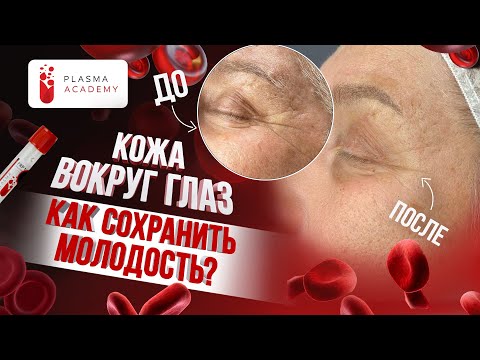 Видео: 💉Как избавиться от темных кругов под глазами и отеков? PRP и PRF терапия для омоложения кожи. #prp