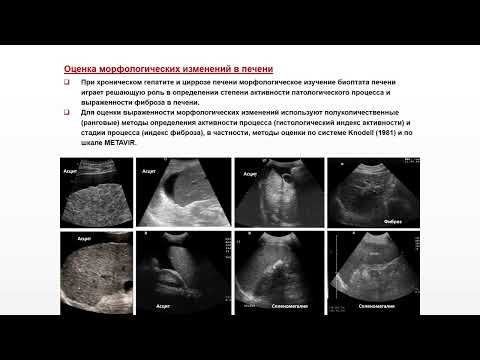 Видео: Ультразвуковая диагностика (УЗИ). Доктор Иогансен. Выпуск 10. Диффузные изменения печени. Часть 2.