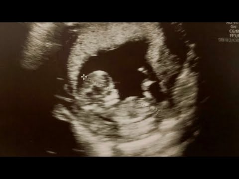 Видео: Ездили  на второй скрин. Теперь мы знаем кто у нас в животике🥰 