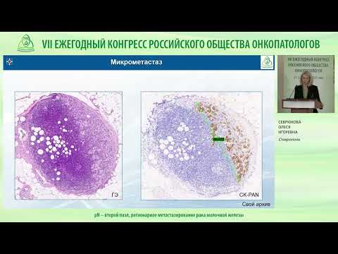 Видео: pN – второй пазл, регионарное метастазирование рака молочной железы