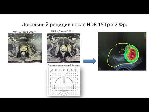 Видео: Место брахитерапии в лечении локализованного рака предстательной железы. Цыбульский А.Д.