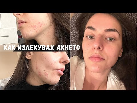 Видео: СПРАВИХ СЕ С АКНЕТО!!! Skincare, Антибиотик, Процедури, Храна и Колко струваше това за 3 месеца