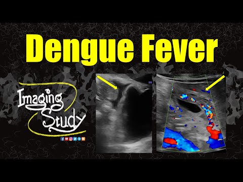 Видео: Лихорадка Денге || Ультразвук || Случай 365