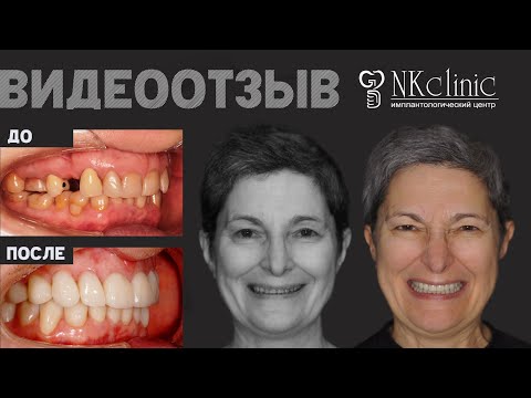 Видео: 12 лет мучилась от невралгии языкоглоточного нерва из-за неправильного прикуса. Отзыв о лечении